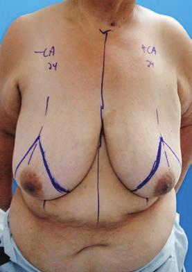 In these women, the areola may be placed as a skin graft, as previously described.
