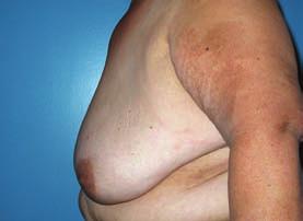 flap coverage without raising the pectoralis major and guaranteeing a tension-free skin