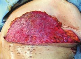 1 -K This woman presented with invasive cancer of the left breast; the right breast was