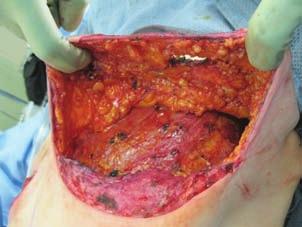 invasive and ductal carcinoma in situ (IS) of the