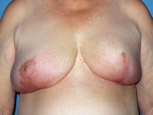 and 728 g from the left breast (ig. 2, ).