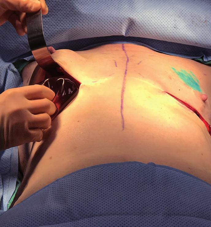 The first step in the procedure is to check the mastectomy skin perfusion with the SPY, or other flap perfusion monitoring devices, with an appropriate breast sizer in place.