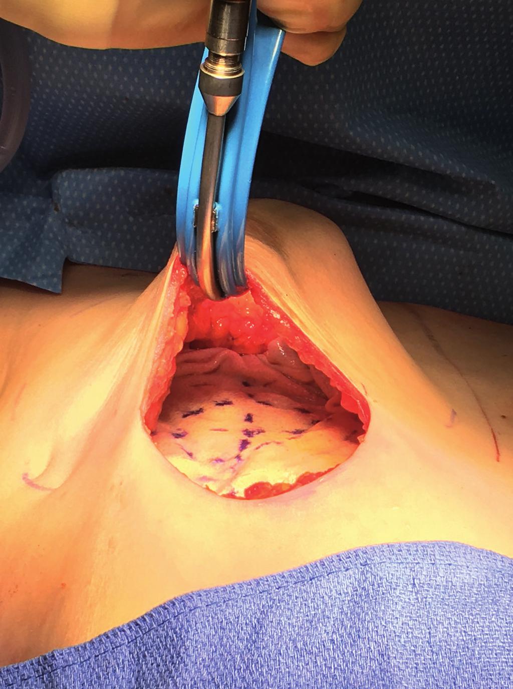 A lighted retractor is then used to expose the pocket up to the top of the pectoralis. Here the top of the breast can be determined by correlating with the preoperative markings.