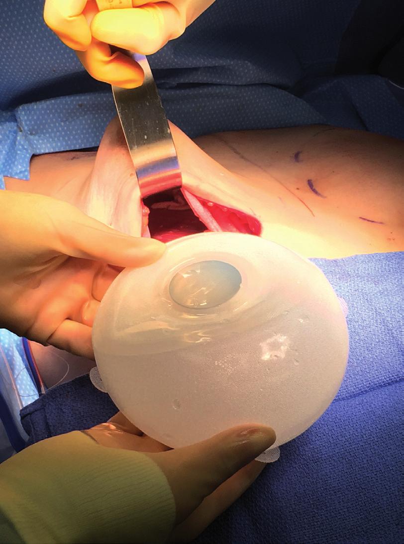 2-0 Ethicon MONOCRYL Suture is used starting at the meridian of the breast at the top of the pectoralis and run medially to the inframammary fold.