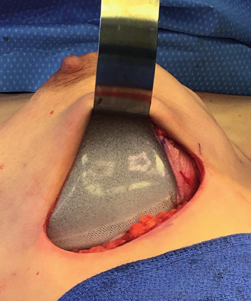Enough opening needs to be left at the inframammary fold to accommodate placing the implant with an introduction device, or placing a folded Tissue Expander.