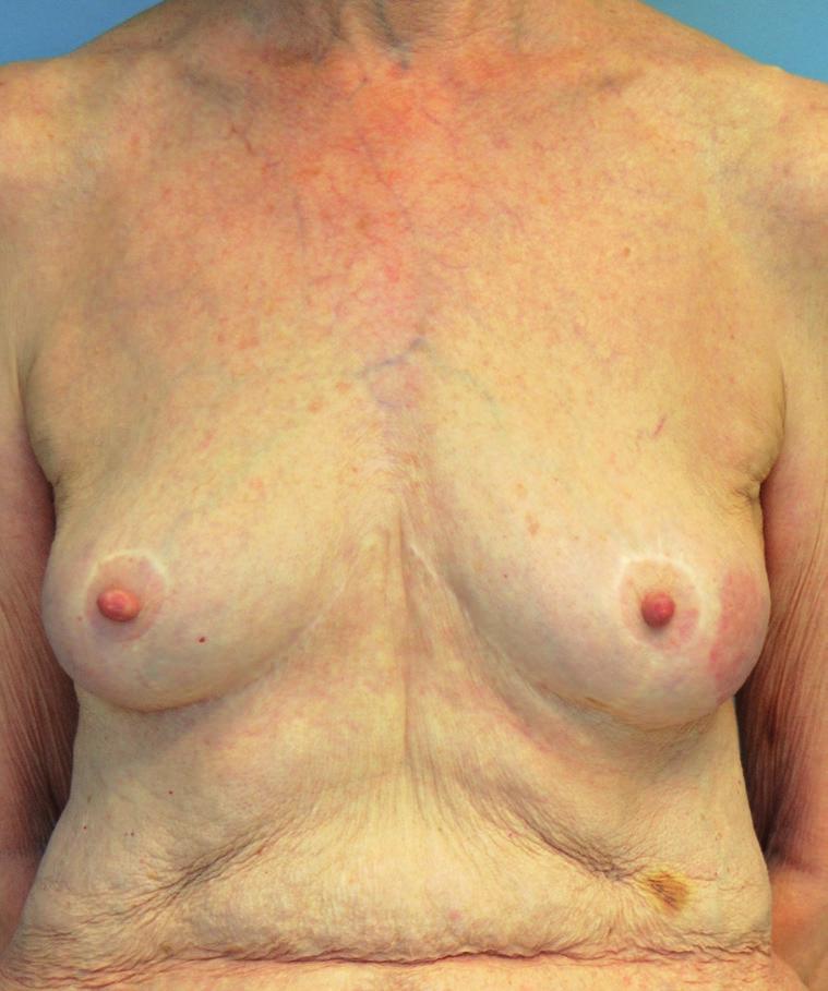 CLINICAL CASES CASE 2: This patient had a previous mastopexy, but desired a similar breast size, therefore a