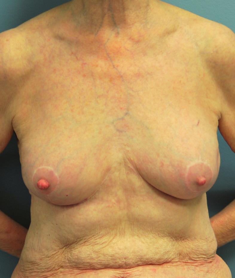 Her postmastectomy nipple perfusion was found to be excellent, and she underwent direct to implant