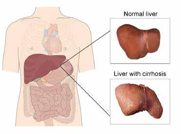 If the harm to your liver continues, the inflammation and fibrosis can spread throughout your liver, changing its shape and affecting how well your liver cells work.