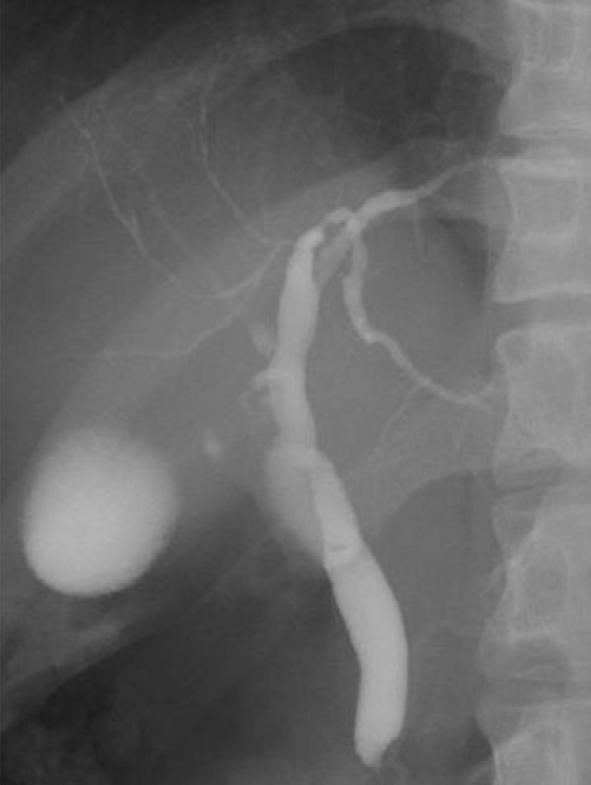 Figure 1. ERC showed diffuse stricture and dilatation of the intrahepatic bile duct. sodeoxycholic acid (UDCA) (600 mg/day).