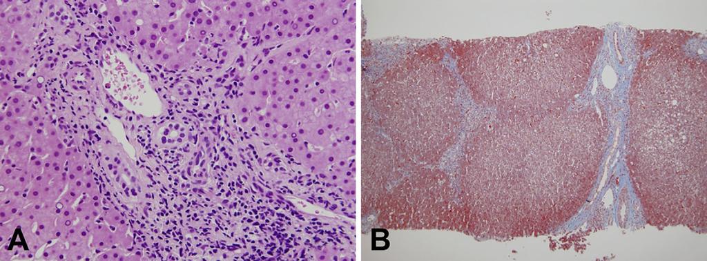 Figure 2. The histological findings in a liver biopsy specimen taken in October 2011.