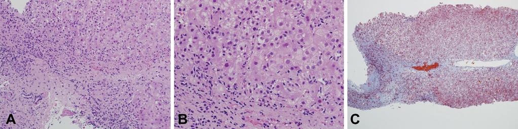 (C) Masson trichrome staining showed no findings of biliary fibrosis (original magnification 100). Figure 9. The histological findings in a liver biopsy specimen taken in June 2015.