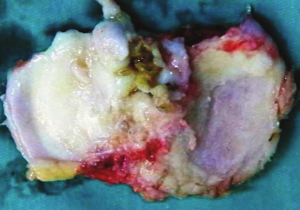 Very severe injury: Grade 4a penetration of the subchondral bone, but not the overall diameter of the defect Grade 4b penetration throughout the entire diameter of defect 1 2 3 Moderate destruction