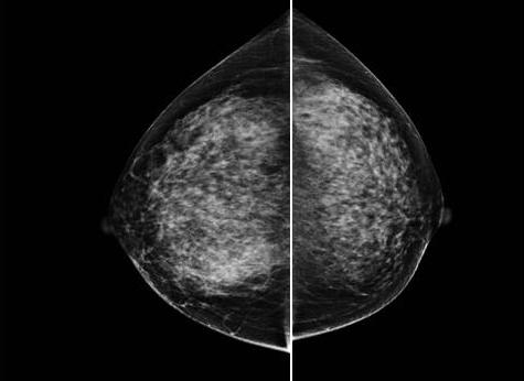 follow-up mammography revealed a solitary, ill-defined mass on the right breast (Figure 4).