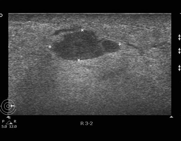 A cystic lesion is observed without other suspicious findings, excluding edematous change. A B C D Figure 6.
