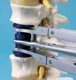 decompression of neural elements and restores normal spinal alignment Restore lordosis/ kyphosis Angled implant endplates are designed to allow