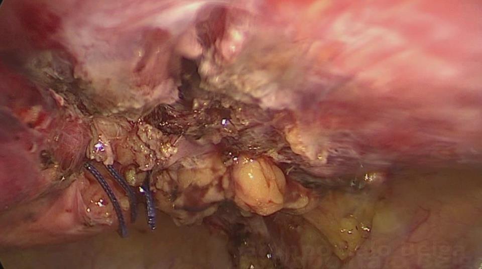 Spigelian hernia in gynecology After laparoscopy : 3