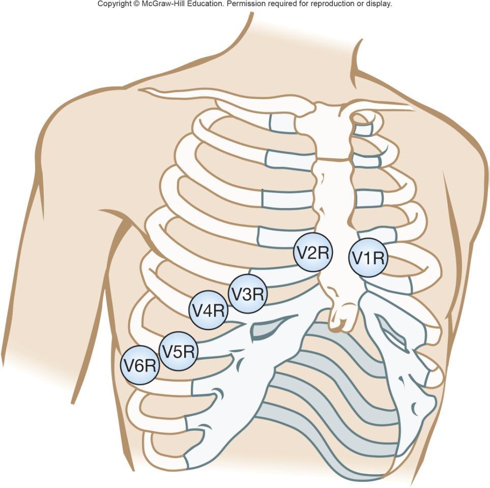 4.12 Dextrocardia Dextrocardia heart on right side Reverse leads from normal