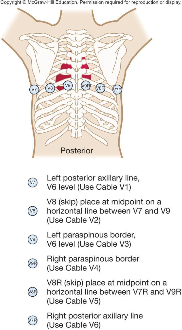 4.12 Posterior 12-Lead ECG Electrode placement: V7: left posterior axillary line V8: under left midscapular line V9: