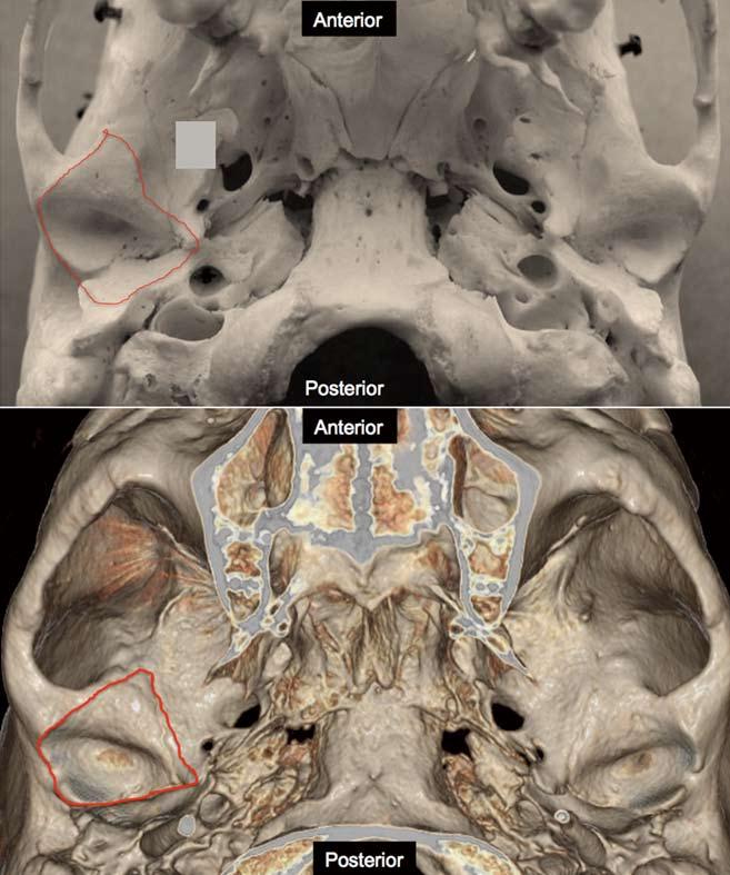 A B Anterior Figure 1 Antomy of the rnil omponent of temporomndibulr joint. A: Photogrph of skull speimen; B: 3-D volume rendered imge obtined from temporl bone Redline demonstrtes the psulr tthment.