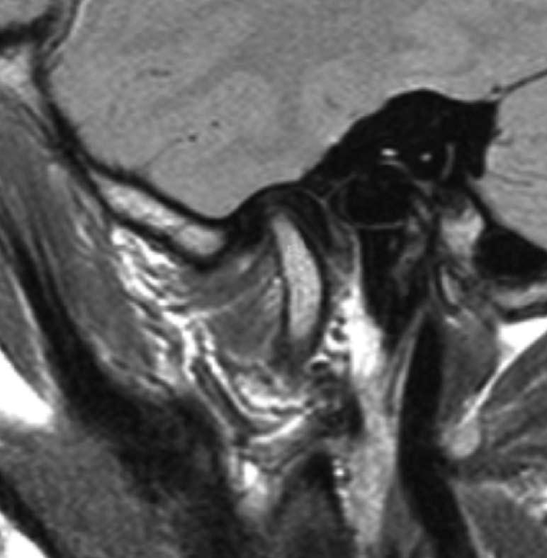 proton density weighted MRI in the open mouth position demonstrtes redution of the disk (rrow) between the rtiulr eminene (the letter, ) nd the mndibulr ondyle (the letter, ).