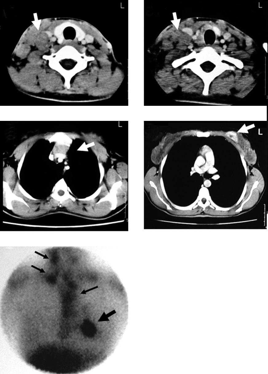 Case report: 67 Ga accumulation in a breast fibroadenoma (a) (b) (c) (d) (e) Figure 1.