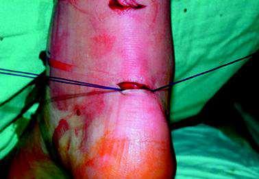 PERCUTANEOUS REPAIR Benefits Less wound complications Less tendon