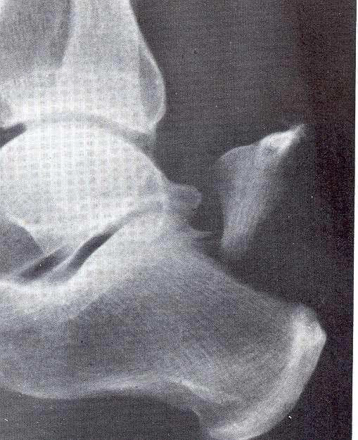 IMAGING X-ray Lateral ankle X-ray to