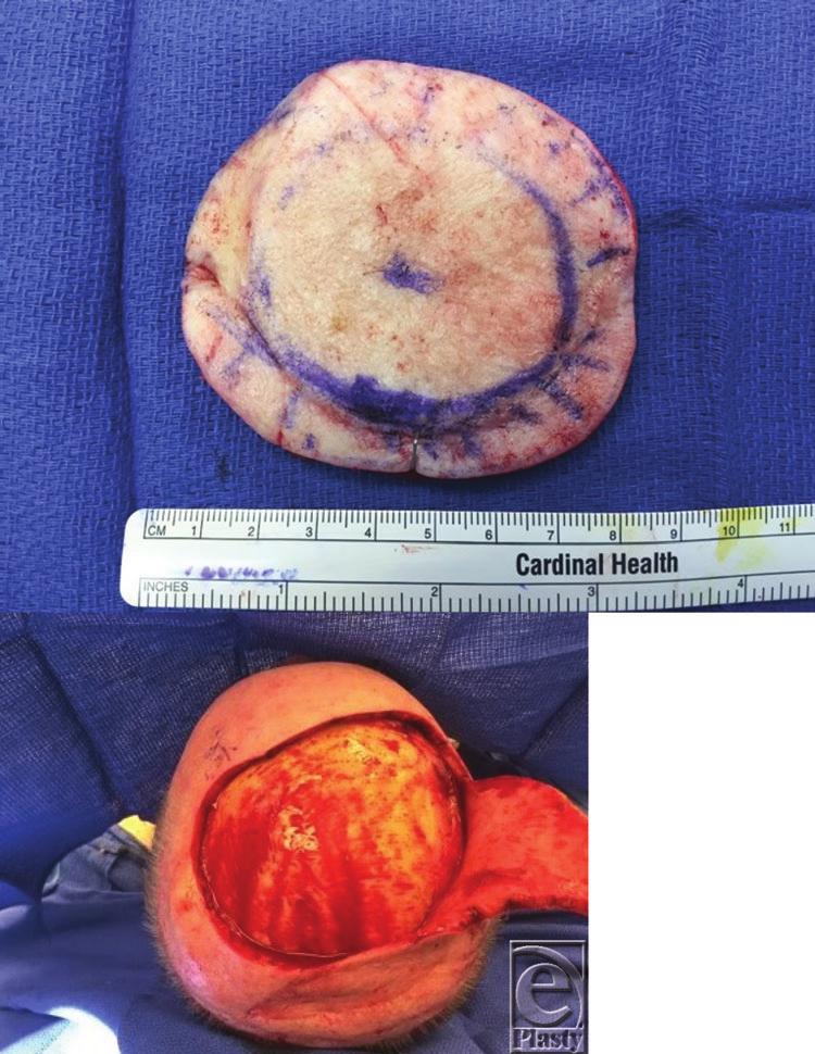 Figure 2. DESCRIPTION A 69-year-old man presented with a 2-year history of a recurrent, nonpigmented, nodular scalp lesion. He underwent surgical excision with scalp flap reconstruction.