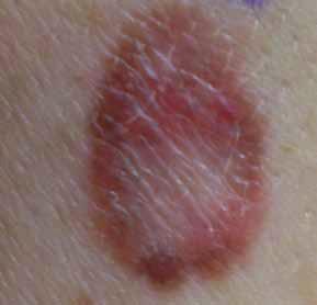 MELANOCYTIC LESIONS: EFFECTIVE MANAGEMENT IN PRIMARY CARE: Part 2 In the second part of our feature on pigmented skin lesions, dermatology specialist Dr Sweta Rai describes the steps to rational