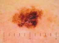 distribution and therefore in the early detection of melanoma. 5 Special training in the use of a dermoscope is required and beginners may have a higher false positive referral rate.