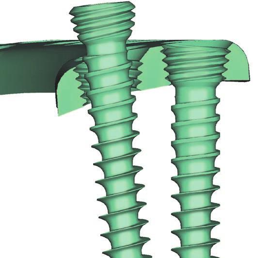 TSLP Thoracolumbar Spine Locking Plate. Anterior thoracolumbar spine locking plate.