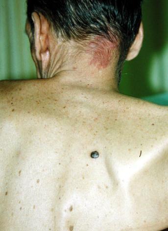 Nodular melanoma (NM) 15% of melanomas
