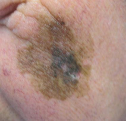 Lentigo maligna melanoma 10-15% of melanomas prolonged radial growth changing