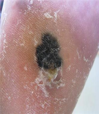 Acral lentiginous melanoma (ALM) 1-3% of melanomas flat