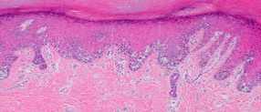 ADULTS case 2 : HISTOLOGY ACRAL MELANOMA Proliferation of spindle and epithelioid cells