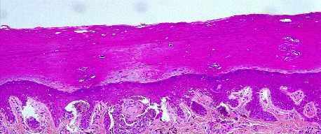 ADULTS : ACRAL MELANOCYTIC TUMOR differential