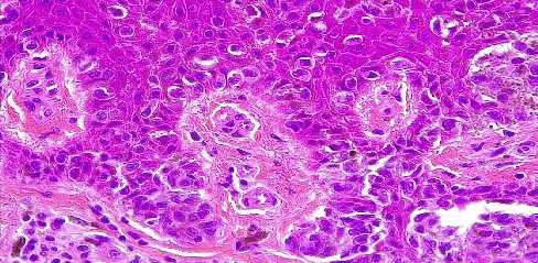 epidermal ascent cells Atypia, no mitosis
