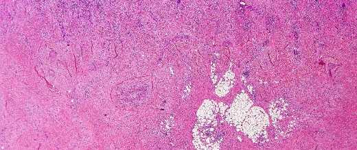 ADULTS case 3: DESMOPLASTIC MELANOMA Malignant melanoma cells with fibrosis Desmoplastic melanoma is more common in males (65%) than females.