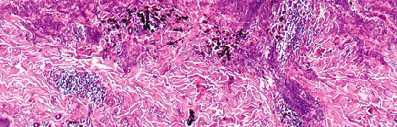 epidermis and the tip toward the reticular dermis/ sub cutis The cells are epithelioid or spindle in nests with pigments deposits The