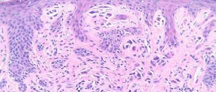 Atypia Upper mitosis Epidermal spread not in upper