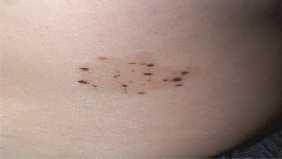 PAYA: OTHERS MELANOCYTIC T IN CHILD Spilus nevus (Congenital Speckled Lentiginous Nevus) Alternating flat and raised