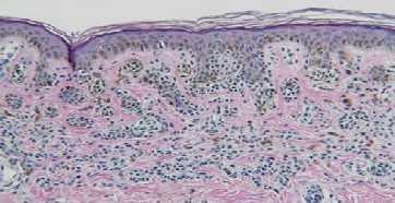 basal layer in association with melanophages in the upper dermis Raised areas showing nests of typical melanocytes at