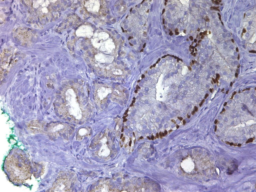 Prostate carcinoma P63 stains