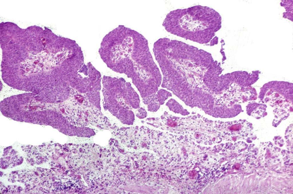 1 urothelial