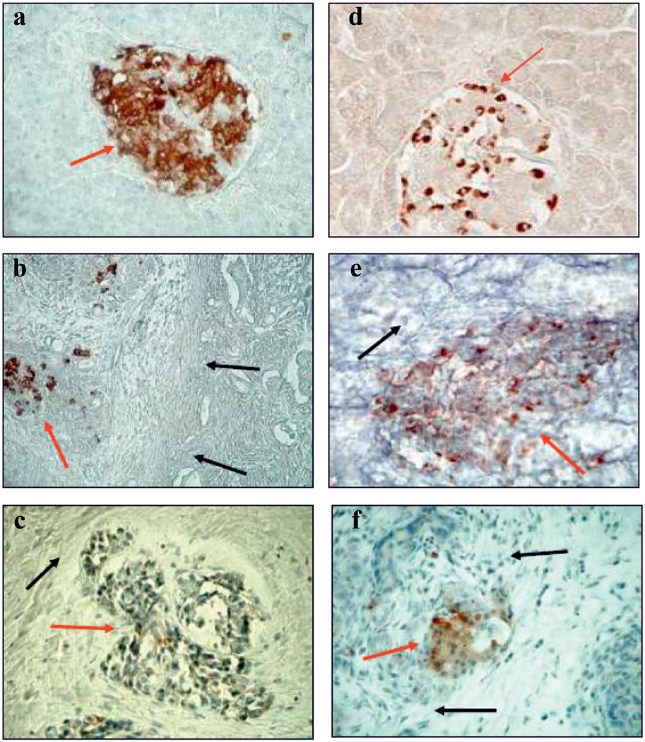 Śliwińsk-Mossoń et l. 253 Figure 2. Immunohistochemicl locliztion of insulin (, b, c) nd glucgon (d, e, f) in norml pncres nd pncres from nonsmoking nd smoking CP ptients with dibetes.