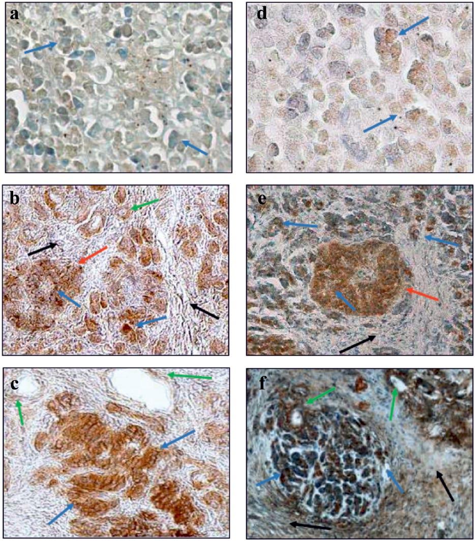 Śliwińsk-Mossoń et l. 251 Figure 1. Immunohistochemicl locliztion of IL-6 (, b, c) nd ET-1 (d, e, f) in norml pncres nd pncres from non-smoking nd smoking CP ptients with dibetes.