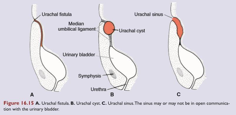 2. Anomalies of the urachus Patent urachus Communication between the bladder and umbilicus through a urachus Urachal