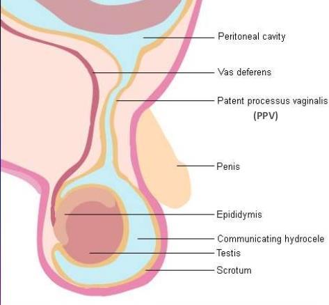 Before descent of the testis, a peritoneal diverticulum called processus vaginalis creates and traverses the inguinal canal down to the scrotum.