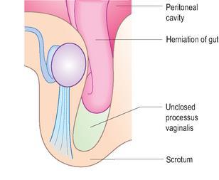 vaginalis and forms a scrotal hydrocele.
