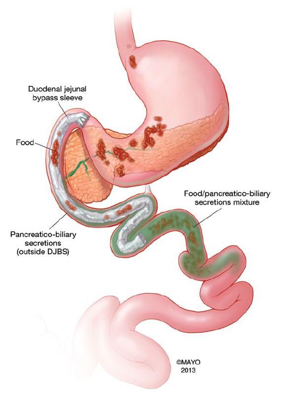 Duodenal jejunal bypass sleeve Endoscopically Side effects (3-5%): placed device consisting Pain of the sleeve that is deployed Nausea/vomiting and an anchor that sits at the duodenal bulb.